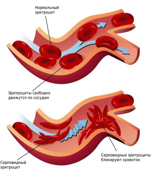 Нарушение кровотока при серповидноклеточной анемии