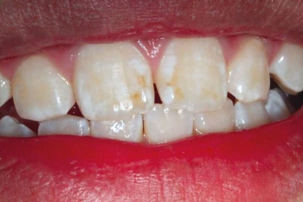 Некариозное поражение зубов 