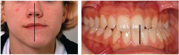 Несоответствие центральной линии зубов и лица