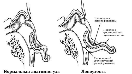 Нормальная анатомия уха и лопоухость