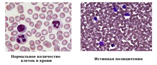 Нормальное количество клеток в крови и истинная полицитемия