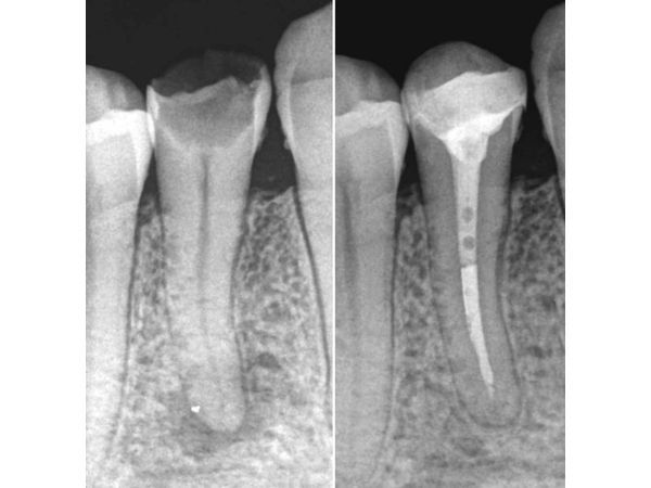 Рентгеновские снимки до и после лечения