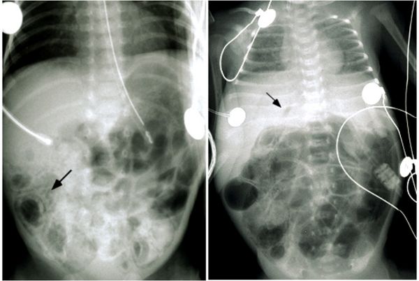 Обширный пневматоз кишечника (слева) и подозрение на газ в системе воротной вены или пневмоперитонеум (справа) 