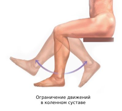 Ограничение движений в коленном суставе