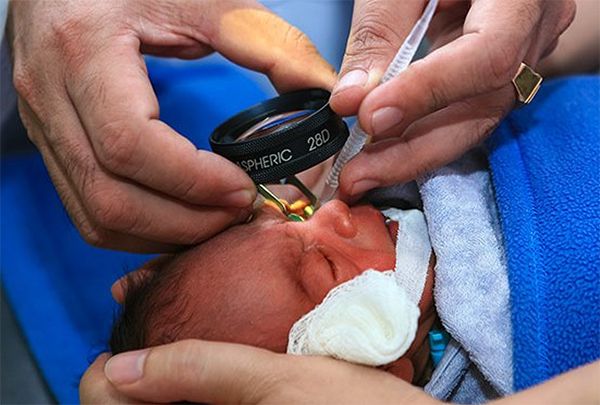Осмотр глазного дна младенца с помощью лупы 