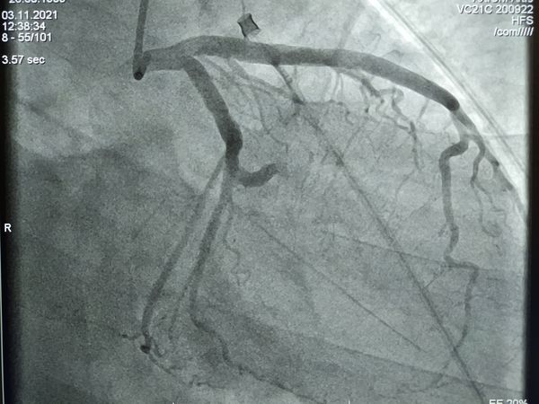 Огибающая артерия сердца, которую закрыл тромб
