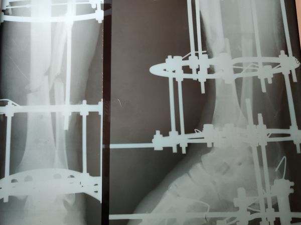 Рентгенограмма после корригирующей резекции левой голени и фиксации аппаратом Илизарова