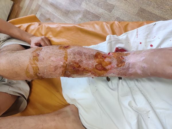 Нога после демонтажа аппарата Илизарова
