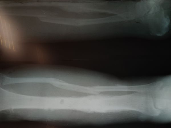 Рентгенограмма после демонтажа аппарата наружной фиксации 