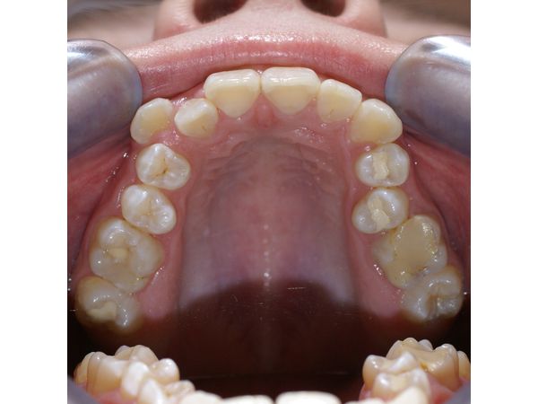 Верхний ряд зубов до лечения