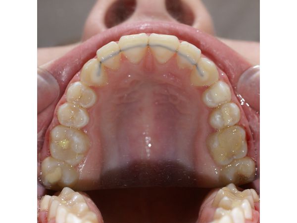 Верхний ряд зубов после лечения
