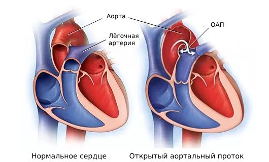 Открытый артериальный проток 