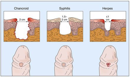 Отличие мягкого шанкра от сифилиса и герписа