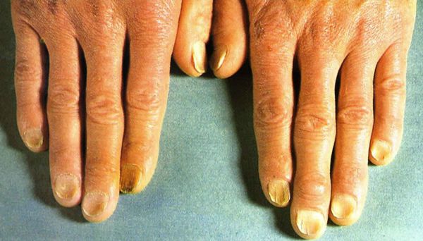 Пальцы и ногти при вибрационной болезни