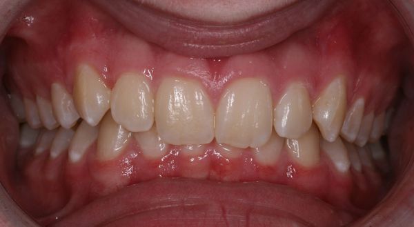 Передние зубы верхней челюсти перекрывают зубы нижней челюсти