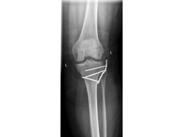 Рентген после операции