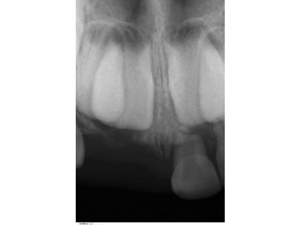 Прицельный рентгенологический снимок через год после травмы