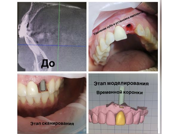 Перелом корня переднего зуба: случай удаления, имплантации и установки временной пластиковой коронки за один приём