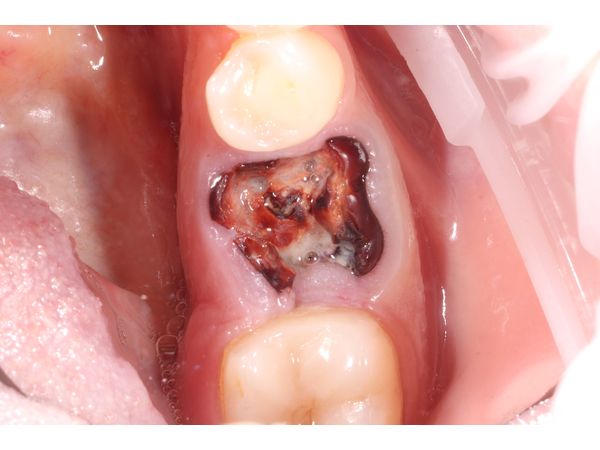 Периодонтит почти полностью разрушенного зуба: случай удаления корней и установки дентального импланта за один визит