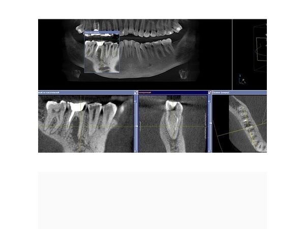 КЛКТ зуба 4.6 до лечения