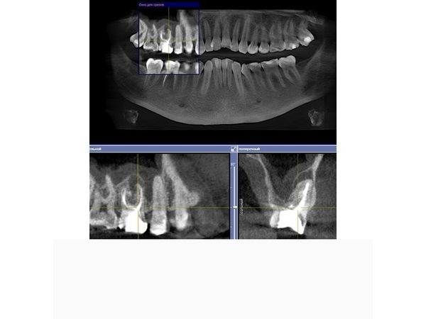 КЛКТ зуба 1.6 до лечения