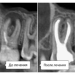 https://dgp1nn.ru/blog/wp-content/uploads/periodontit-zuba-s-bolshim-ochagom-povrezhdenija_5.jpg
