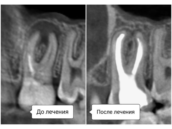 Зуб 2.6 до и после лечения