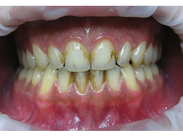 До лечения: пигментированный налёт на зубах