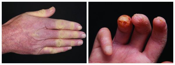 Побеление пальцев и язвы при синдроме Рейно 