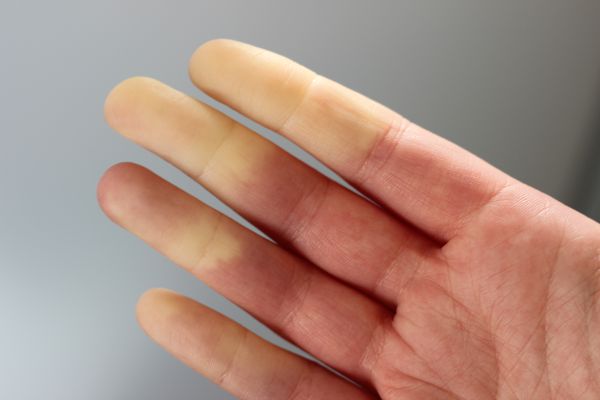 Побеление пальцев при синдроме Рейно