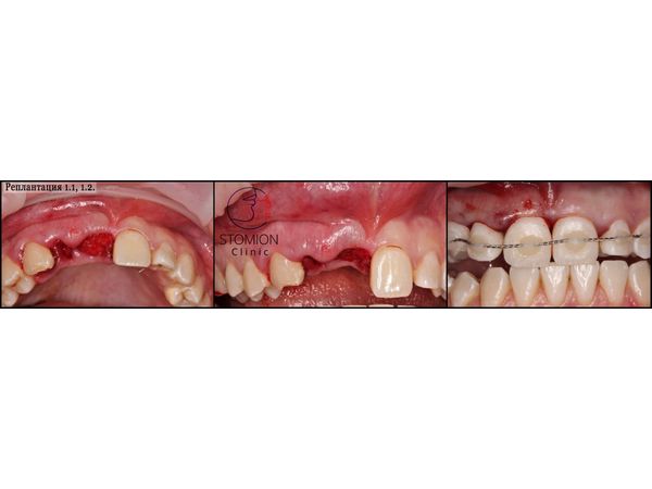 Полный вывих зубов: случай успешной имплантации после восстановления костной ткани