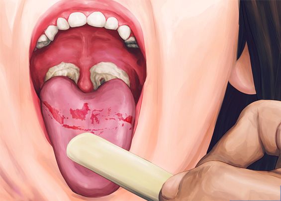 Полость рта при дифтерии