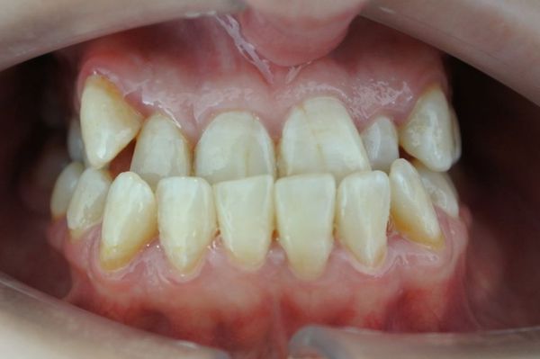 Положение зубов при мезиальном прикусе