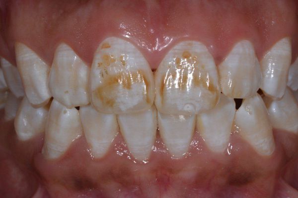 Поражение зубной эмали при флюорозе