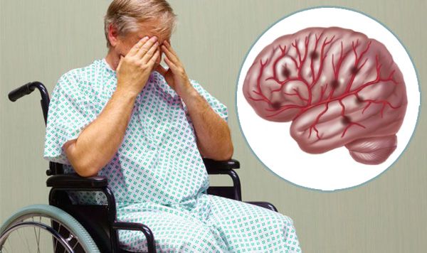 Поражения головного мозга вызывают сосудистую деменцию
