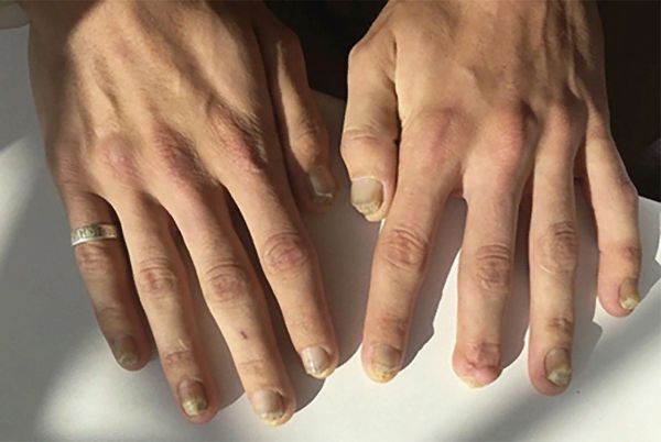 Повреждение ногтей 