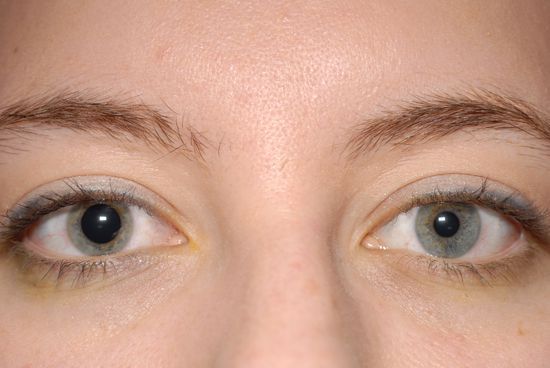 Повреждение зрачка при травме глаза 