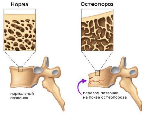 Позвонки в норме и при остеопорозе
