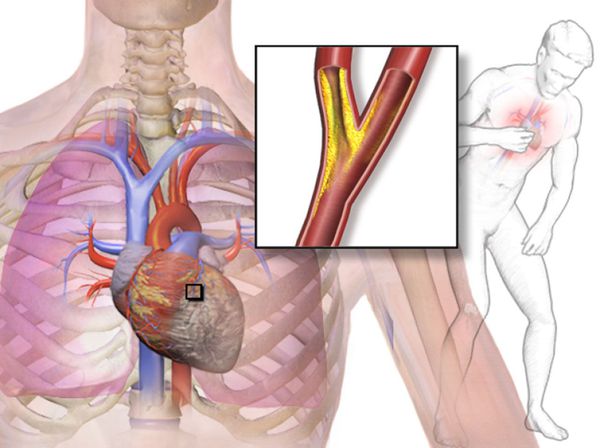 Причина стенокардии: нарушение поступления кислорода в сердечную мышцу