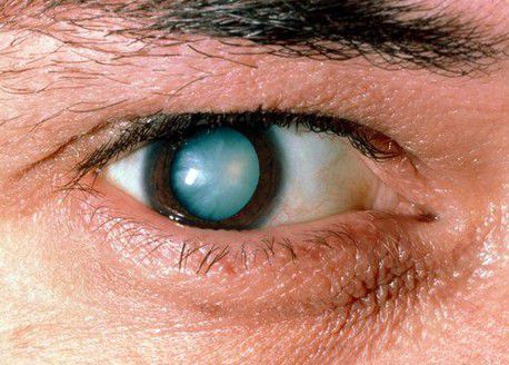 Признак корковой катаракты
