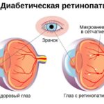 https://dgp1nn.ru/blog/wp-content/uploads/priznaki-diabeticheskoy-retinopatii-s.jpg