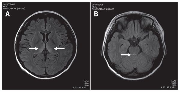 Признаки энцефалопатии Вернике на снимке МРТ 