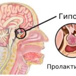https://dgp1nn.ru/blog/wp-content/uploads/prolaktinoma-s-wvnka4j.jpeg