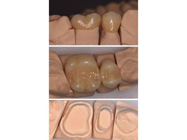Гипсовая модель зубов и керамические коронки на модели