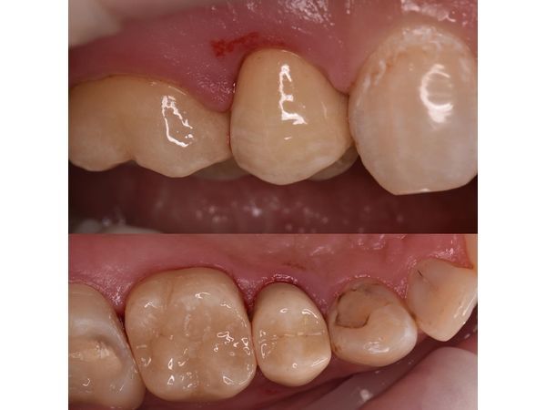 Керамические коронки на зубах. Десна травмирована из-за изоляции коффердамом, который нужен для фиксации коронок. Такие повреждения заживают за 1–3 дня