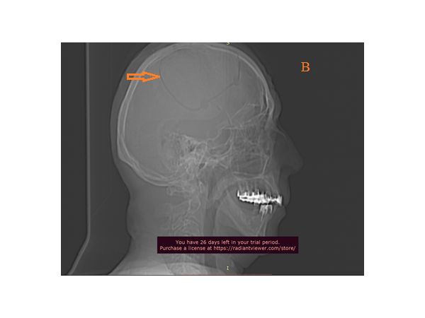 Обзорный снимок КТ после операции: тонкая линия распила костей черепа, выполненная силовой установкой Medtronic