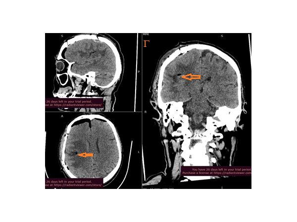 КТ-контроль головного мозга на следующий день после операции: ложе удалённой опухоли