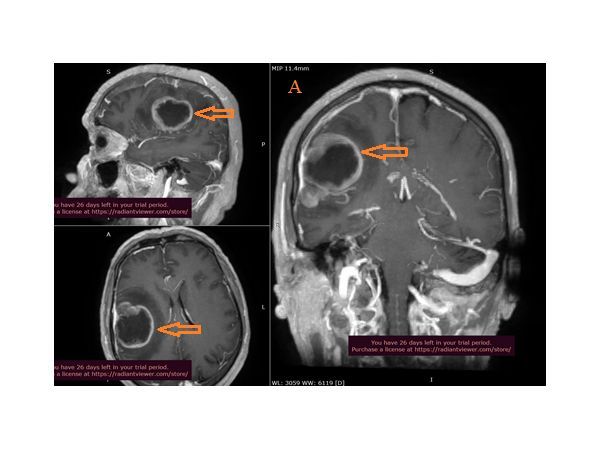 МРТ головного мозга: большая метастатическая опухоль правой лобно-теменной области