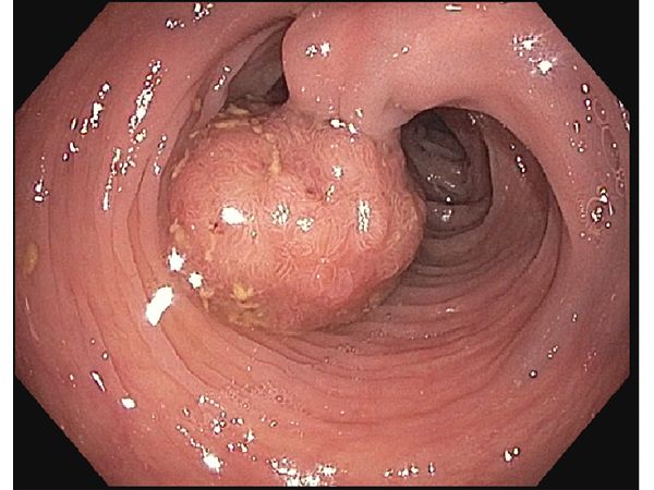 Рак толстой кишки: успешное удаление полипа во время эндоскопии