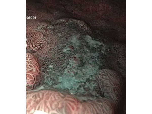 Осмотр раннего рака желудка с помощью цифровой хромоскопии